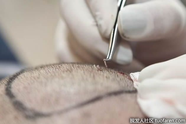 【圖】植髮前需要注意什麼呢？