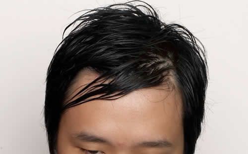 【圖】油性頭皮會導致脱髮嗎?