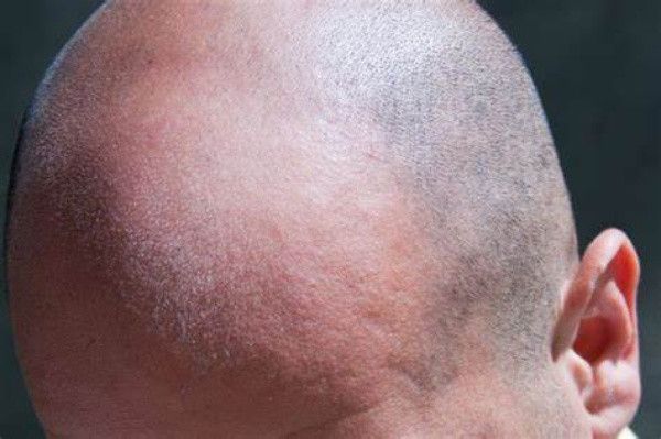 【圖】如何增加頭皮的血液循環