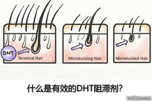 【圖】什麼是有效的DHT阻滯劑？