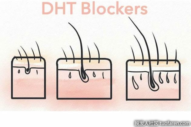 【圖】什麼是DHT阻斷劑？