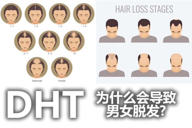 【圖】DHT是什麼?為什麼會導致男女脱髮?