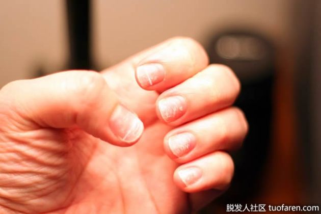【圖】指甲變白意味着什麼？