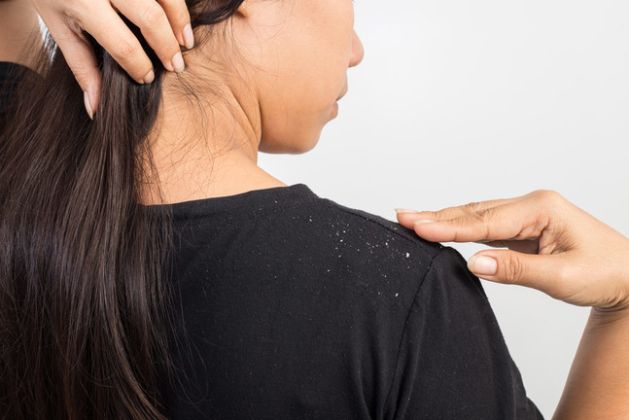 【圖】為什麼人們會有頭皮屑?