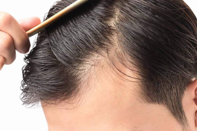 【圖】服用β-谷甾醇用於稀疏頭髮的5個理由