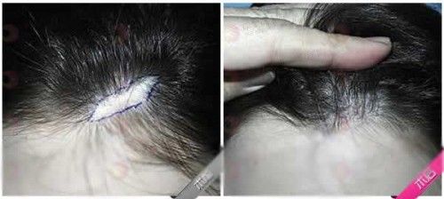 【圖】如何在疤痕組織上生長頭髮