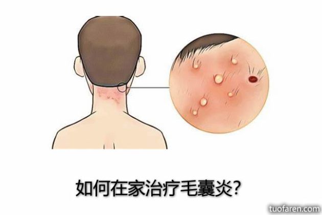 【圖】如何在家治療毛囊炎？
