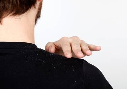 【圖】如何治療慢性頭皮屑