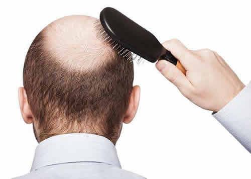 【圖】DHT是脱髮原因 什麼可以降低DHT