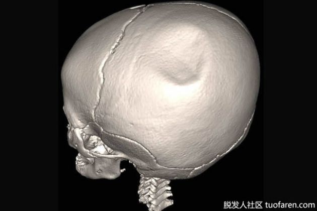 【圖】是什麼導致顱骨凹陷？
