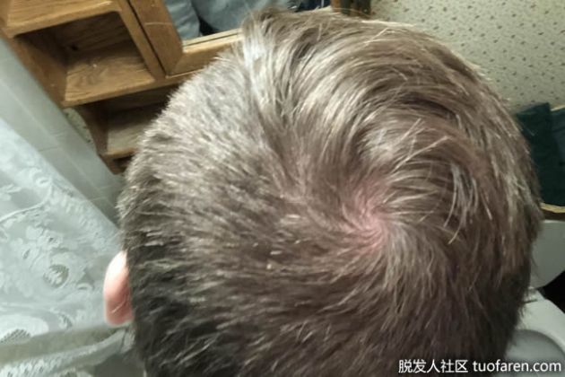 【圖】什麼是發旋或頭髮漩渦？