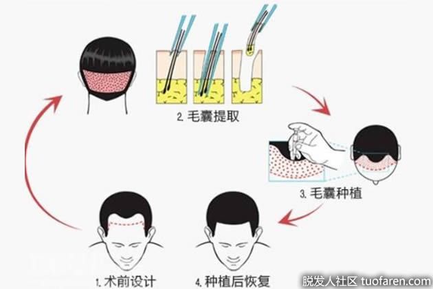 【圖】【中德植髮醫院】《徐霞説》如何判斷植髮手術是否失敗？