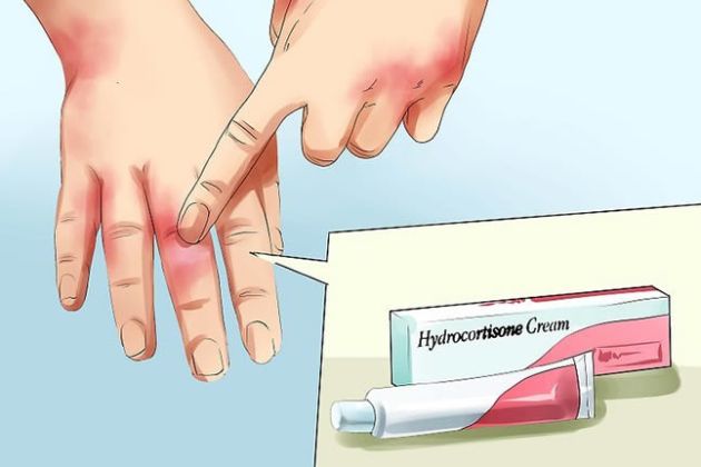 【圖】神經性皮炎是什麼?