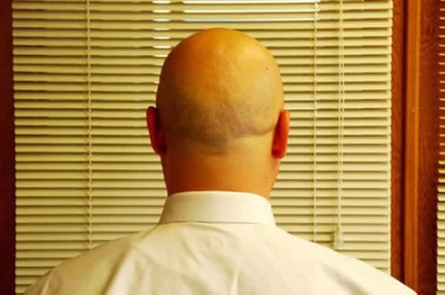 【圖】如何在毛囊根部阻止DHT