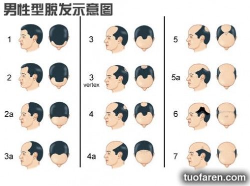 【圖】男性型脱髮示意圖