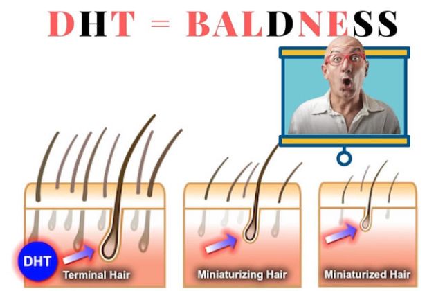【圖】DHT——脱髮問題的重要根源之一