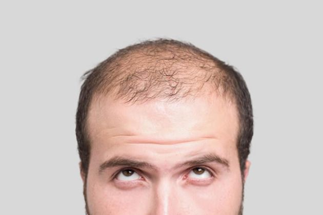 【圖】脱髮的原因和有效的治療方法