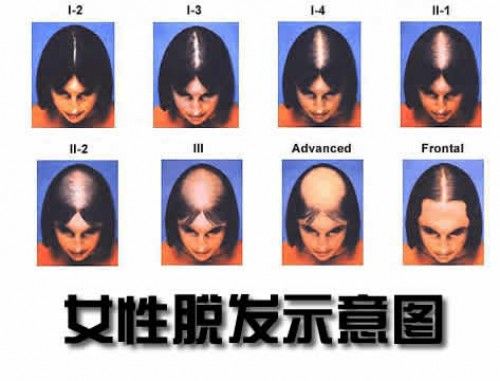 【圖】【必讀】90%女性的脱髮原因及治療
