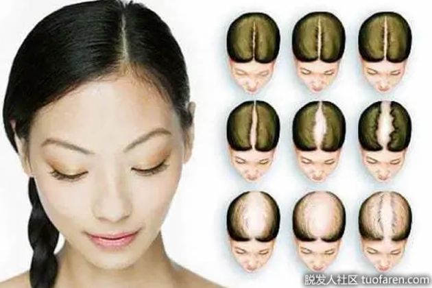 【圖】什麼是女性型脱髮？