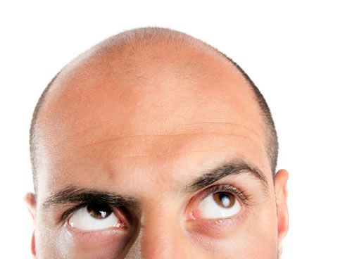 【圖】脂溢性脱髮的原因