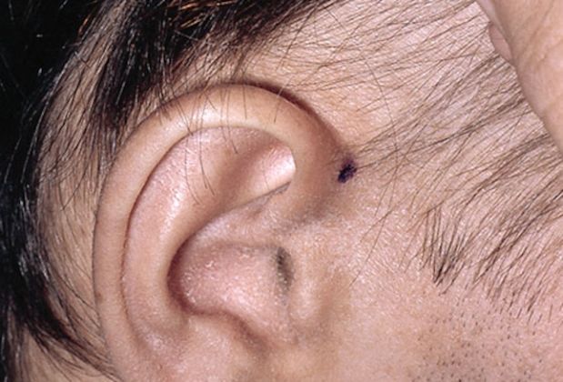 【圖】休止期脱髮圖