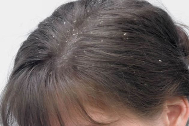【圖】去除頭皮屑的技巧