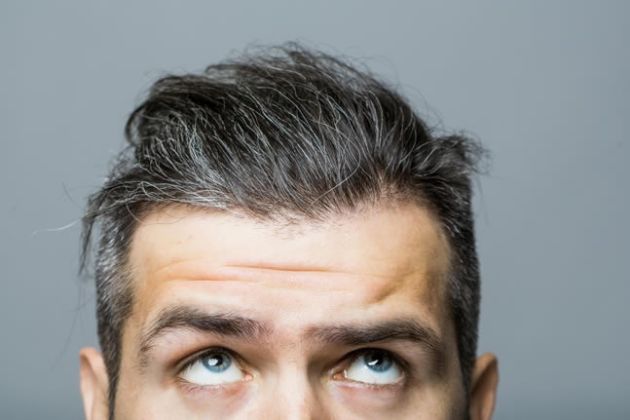 【圖】雄激素性脱髮的原因及治療方法