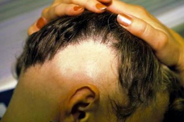 【圖】什麼是蛇形斑禿?