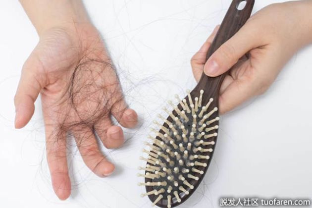 【圖】什麼是女性雄激素性脱髮？