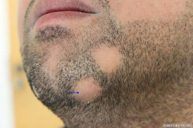 【圖】鬍鬚脱落的原因是什麼?