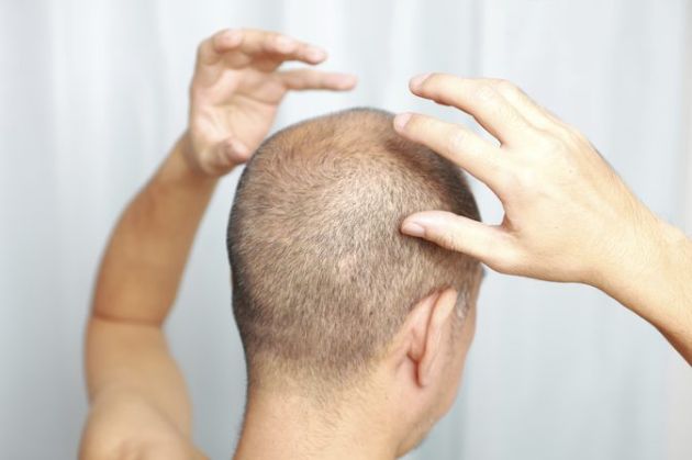 【圖】髮際線後移的原因及治療