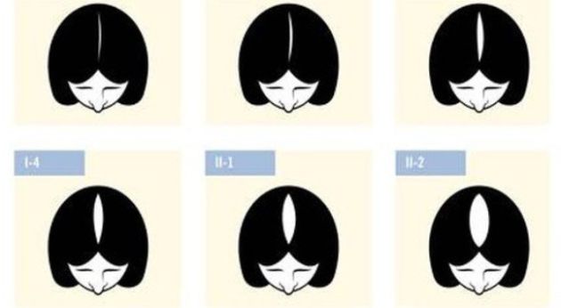 【圖】關於女性髮際線的後退