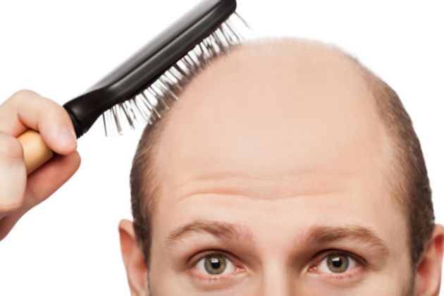 【圖】自然地預防和治癒禿頭