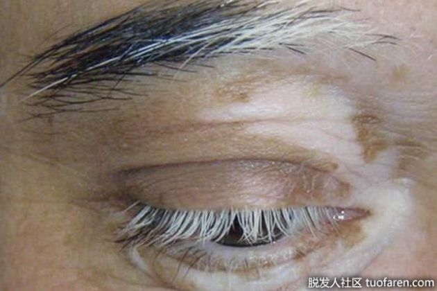 【圖】為什麼我的睫毛變白了？