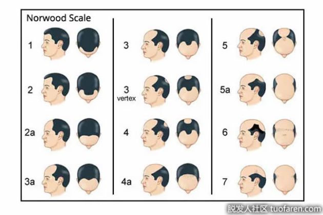 【圖】瞭解男性型脱髮