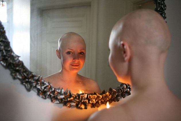 【圖】什麼是普遍型禿髮(普禿)?