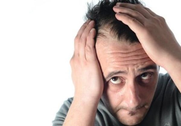 【圖】什麼是髮際線修復?