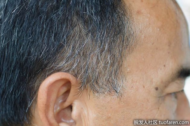 【圖】為什麼我的頭皮上有棕色斑點？