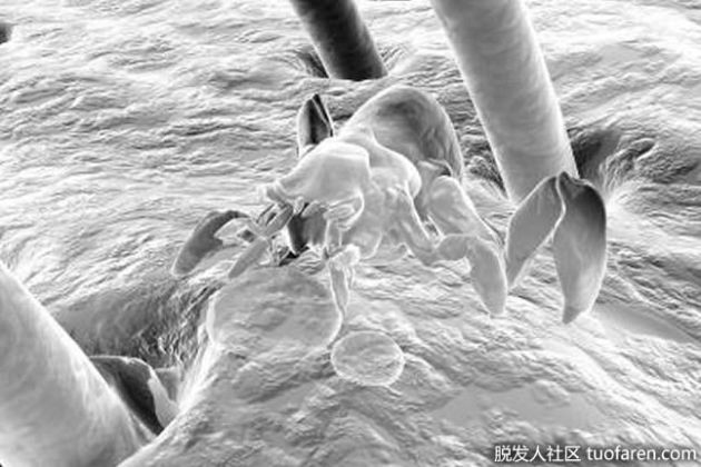 【圖】植物油會殺死蝨子嗎？