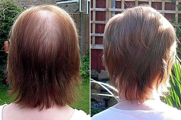 【圖】蛋白質缺乏和脱髮