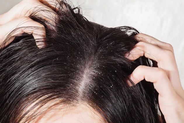 【圖】頭屑的常見原因是什麼？