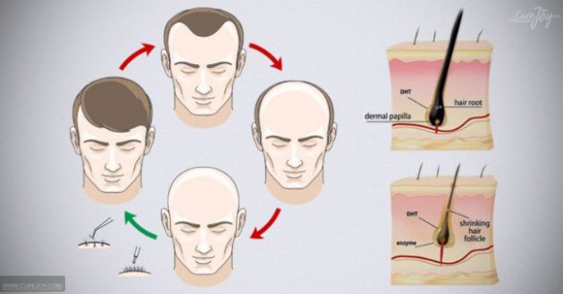 【圖】手淫會導致脱髮嗎?科學説什麼