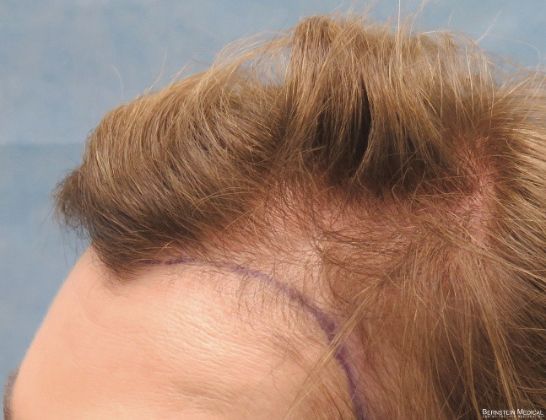 【圖】太陽穴脱髮:可以預防或治療嗎?