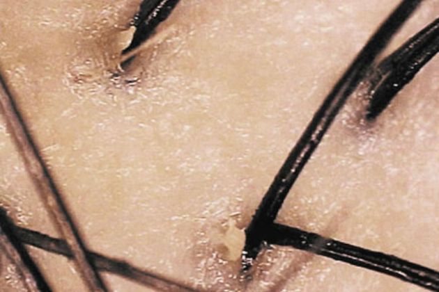 【圖】導致乾性頭皮和油性頭髮的常見原因是什麼?