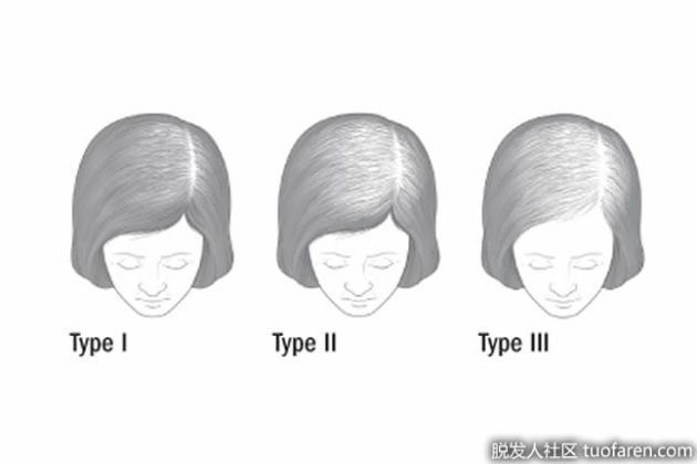 【圖】老年女性頭髮稀疏的常見原因是什麼？