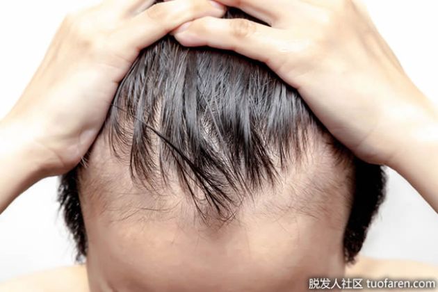 【圖】對你的髮際線後退採取行動