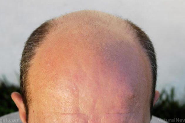 【圖】瞭解禿頂的原因、類型和家庭療法