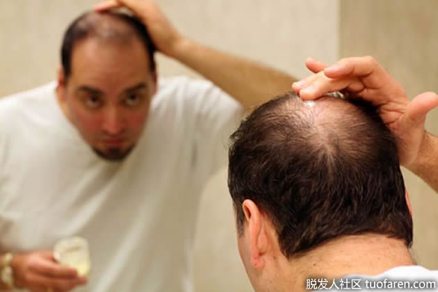 【圖】男性毛髮再生治療