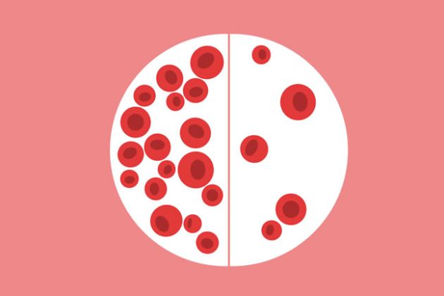 【圖】缺鐵性貧血有哪些症狀?