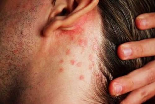 【圖】瞭解如何阻止脂溢性皮炎的脱髮